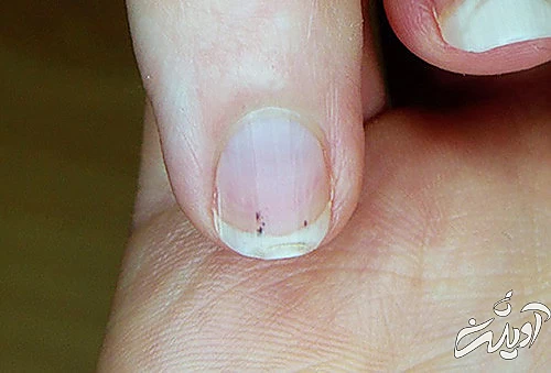 علائم سکته قلبی؛ ۱۲ نشانه ساده اما مرگبار